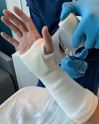 Image result for Short Arm Cast