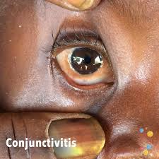 Image result for Conjunctivitis Resources