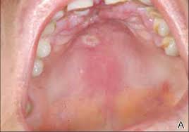 Tuberculosis cutis — localización de la tuberculosis en la piel; Tuberculosis Cutis Orificialis In An Immunocompetent Patient Mdedge Dermatology