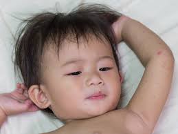 Is Bathing In Bleach Safe For Treating Eczema Babycenter Canada