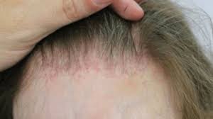 Hairs can be easily pulled out. Lichen Planopilaris Lpp Treatment In Delhi Derma Miracle Clinic