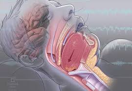 Image result for Obstructive Sleep Apnea