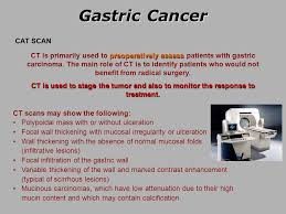 Signs that may be observed with stomach cancer include: Gastric Cancer Ppt Video Online Download