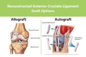 The graft or ligament is then. What Type Of Graft Should I Choose For My Acl Reconstruction Surgery The Knee Joint