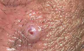 This may just cause the infection to go deeper into your. Tmi Pic Freckle Turned Into Cyst Looking Thing On Vulva Babycenter