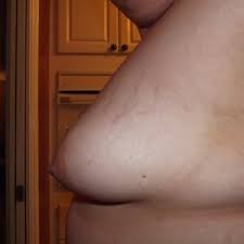 Poland syndrome requires soft tissue augmentation of the affected side, whereas gynecomastia necessitates reduction of the breast tissue. Do I Have Tuberous Breasts Or Poland S Syndrome Photo