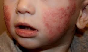 Vinculan La Exposicion Del Feto A Antibioticos Con Dermatitis