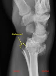 Although the direction indicated by proximal and distal is always respectively towards or away from the point of attachment, a given structure can be either proximal or distal in relation to another point of reference. Angulation Displacement Dislocation Department Test Feinberg School Of Medicine Northwestern University
