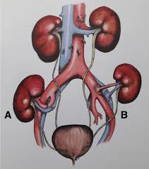 Image result for Transplantation