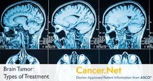 Image result for what is the treatment of brain tumor
