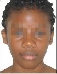 Treatment of a Class 2 biproalveolia in a patient of Burkinabe origin