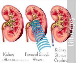 Lithotripsy Purpose Techniques Procedure Advantages Disadvantages Risks Renal Calculi Gallbladder Stones Renal