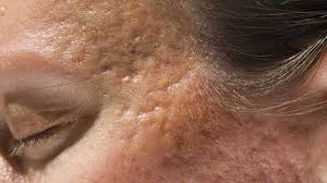 It contains citric acid which lightens scars and vitamin c which helps the skin regenerate new cells. Acne Scars Treatment Removal Best And More