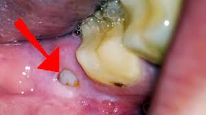 For wisdom teeth swelling caused or exacerbated by pieces of food lodged in the area, rinsing the mouth out with salt water or an oral rinse recommended by your dentist can remove trapped food and clean the area, allowing your body to reduce swelling and pain. Wisdom Tooth Pain What You Need To Know Oral Sedation Home Remedies And What To Expect Youtube