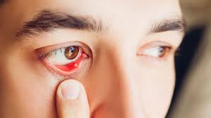 This article examines their causes and treatment options. Stye Inside The Eyelid Overview And More