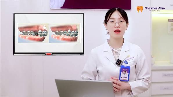 NIỀNG RĂNG TẠI SAO LẠI PHẢI NHỔ RĂNG SỐ 4, SỐ 5? , Đ&acirc;y c&oacute; lẽ l&agrave; lo lắng của  rất nhiều kh&aacute;ch h&agrave;ng khi bắt đầu niềng răng. Vậy tại sao răng số 4 v&agrave; số 5  lại thường được b&aacute;c sĩ c&acirc;n nhắc nhổ trong một số ...