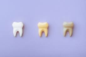 Image result for Tooth Discoloration