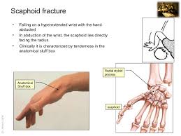 Imaging Anatomy Scaphoid Fracture Want to learn more about it? imaging anatomy scaphoid fracture