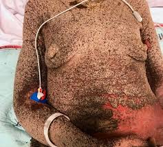 Image result for scabies norvegica