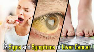 Watch the discussion on 'liver cancer' by dr. 12 Signs And Symptoms Of Liver Cancer Youtube