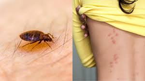 Image result for ant bite