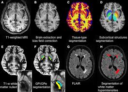 Cohort profile: the Oxford Parkinson's Disease Centre Discovery Cohort MRI substudy (OPDC-MRI) | Fast Fact Now