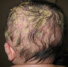 Cradle cap is a harmless skin condition that's common in babies. Ways To Deal With Cradle Cap Starmommy