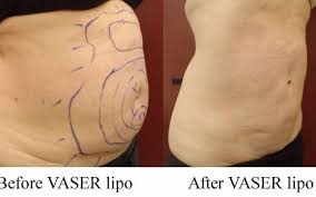 Injections, laser treatments, body contou Vaser Lipo And Botox And Fillers By Medical Face Body Aesthetics In Boston Ma Alignable