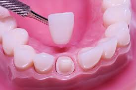 When should you replace a crown instead of re-cementing?