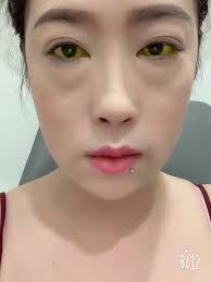 ទើបតែថ្ងៃនេះទេបានដឹងថានៅសល់ភ្នែកតែមួយចំហៀងគឺពិបាកយ៉ាងណា  ដោយសារតែភ្នែកខ្ញុំចាញ់ពន្លឺថ្ងៃខ្លាំងពេកធ្វើអោយពិបាកនឹងបើក ពេទ្យបញ្ជាក់ ...