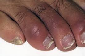 Need to show pics to your doc and more detailed hx. Chilblains Nhs