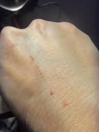 Joel carillet / getty images owner. Wondering If These Are Bed Bugs Bites