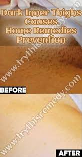 Remedies For Dark Skin Inner Thighs That Works Inner Thigh Dark Skin Thighs