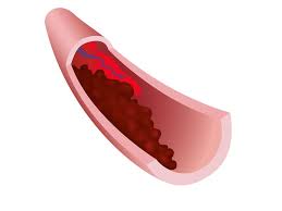 Blood clots can also form in healthy blood vessels when they aren't needed. Why Blood Clots Are A Major Problem In Severe Covid 19 Science Smithsonian Magazine