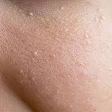Hard pimples on your face or chin are acne. 13 Face Bumps You Get Under Your Skin And How To Get Rid Of Them