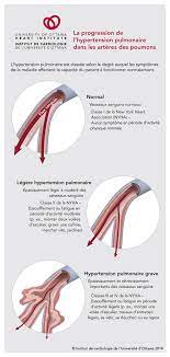 L'essoufflement est la sensation de ne pas avoir assez d'air pour respirer. Hypertension Pulmonaire Institut De Cardiologie De L Universite D Ottawa