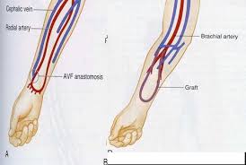 Pin On Av Upper Extremity