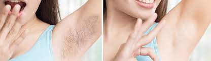 Boston laser hair removal deals: Laser Hair Removal Packages Here In London