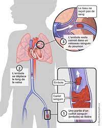 Thrombose Veineuse Profonde