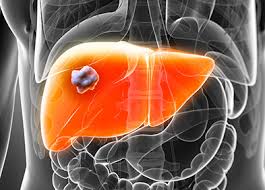 Quels sont les signes, les traitements et les conséquences d'une hépatite ? Cancer Du Foie Facteurs De Risque Symptomes Diagnostic Traitements