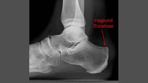 Insertional achilles tendinopathy retrocalcaneal bursitis haglund deformity (i.e. Haglund Exostose Ogam Orthopadie