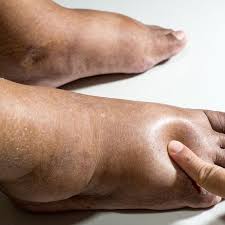 Ada banyak penyebab kaki bengkak. 8 Penyebab Kaki Bengkak Yang Wajib Anda Tahu