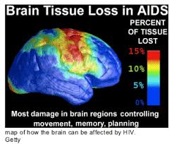 Image result for AIDS Dementia Complex
