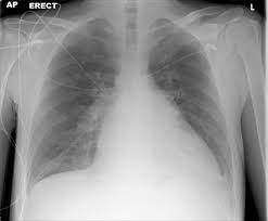 Heart Failure Summary Radiology Reference Article Radiopaedia Org Images were downsampled by uniformly at random. heart failure summary radiology