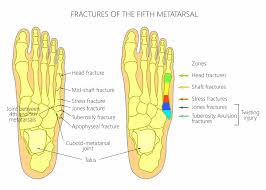 Usually, a surgeon places a long metal rod into the with time, you will add strengthening exercises. Jones Fracture Sussex Foot Ankle Clinic