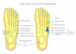 Jones fractures occur acutely, sometimes as a result of sharp, forced pointing and inward turning of the toes. Jones Fracture Sussex Foot Ankle Clinic