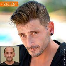 Calvitie Pelade Chimiotherapie Perte De Cheveux Homme Perte De Cheveux Prothese Capillaire
