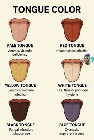 Image result for yellow tongue infection