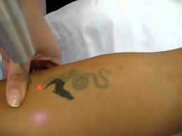 How much does tattoo removal cost? Laser Tattoo Remove Plastic Surgery Istanbul