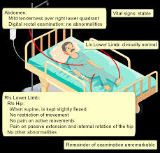 Image result for Psoas Sign